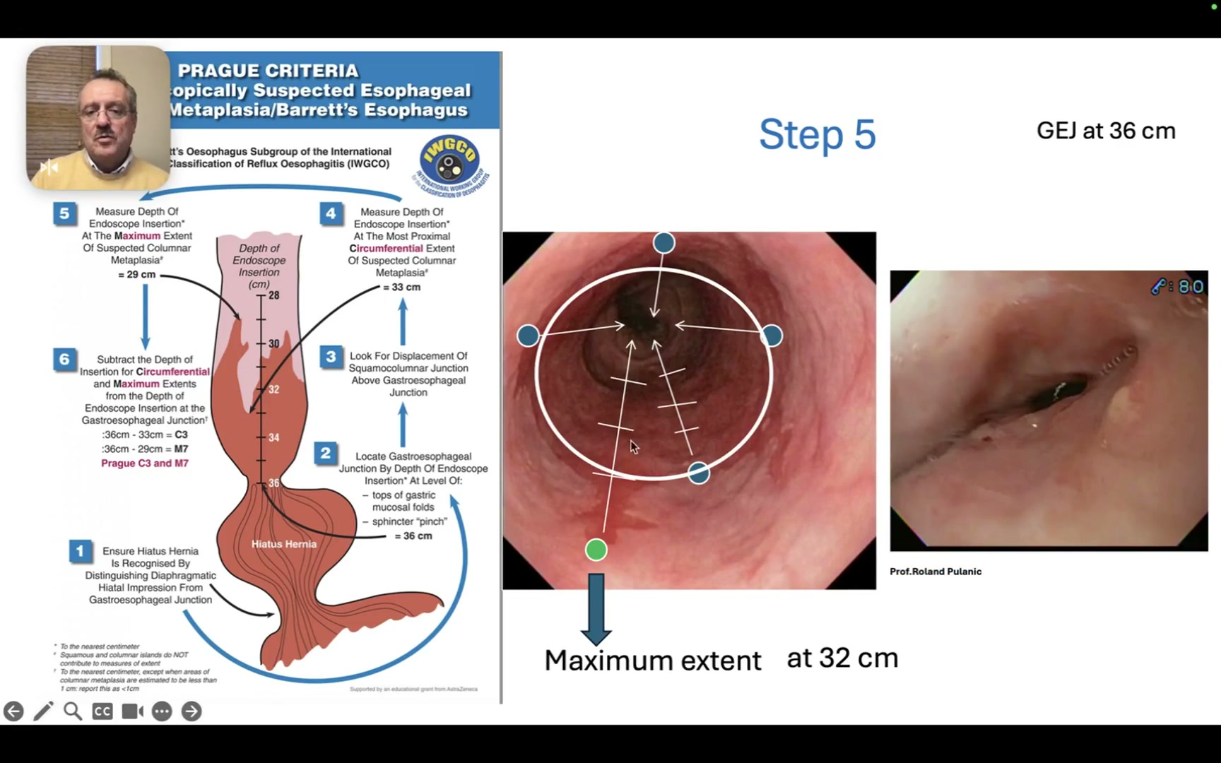 Prague C And M: A 7-Minute Barrett Length Guide 3 Maximum Tongue Extent Marked At 32 Cm