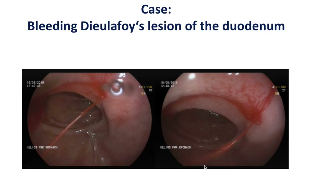 Bleeding On The Right, Channel On The Left: What Would You Do? 1 Case Slide: Bleeding Dieulafoy Lesion Of The Duodenum With A Spurting Vessel On The Right