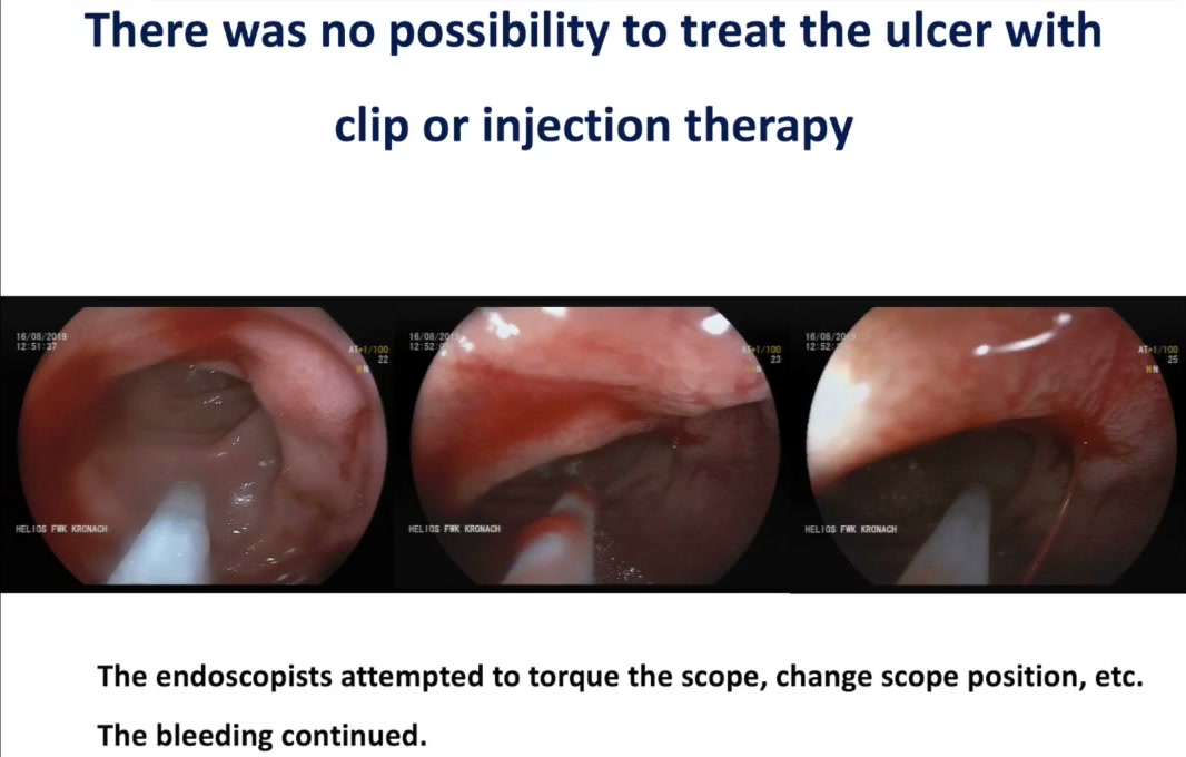 Bleeding On The Right, Channel On The Left: What Would You Do? 2 Slide: No Possibility To Treat With Clip Or Injection; The Endoscopists Torqued The Scope And Changed Position; The Bleeding Continued
