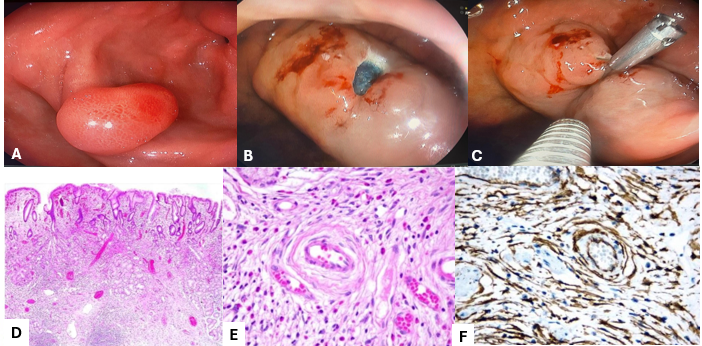 Six-Panel Figure Of A Gastric Vanek Tumor: Three Endoscopic Views And Three Histology And Immunohistochemistry Panels
