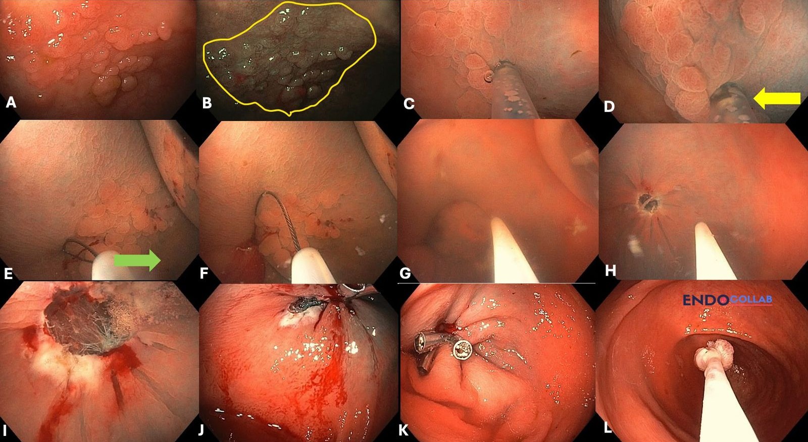 Panel Of Images Of A Flat Cecal Lesion Resected Underwater