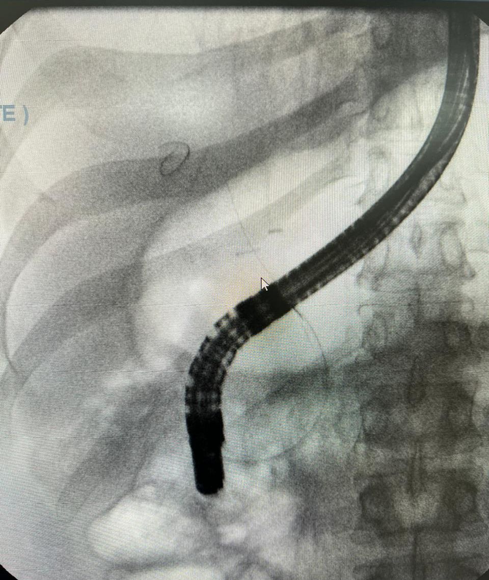 Fluoroscopy Still From The Ercp