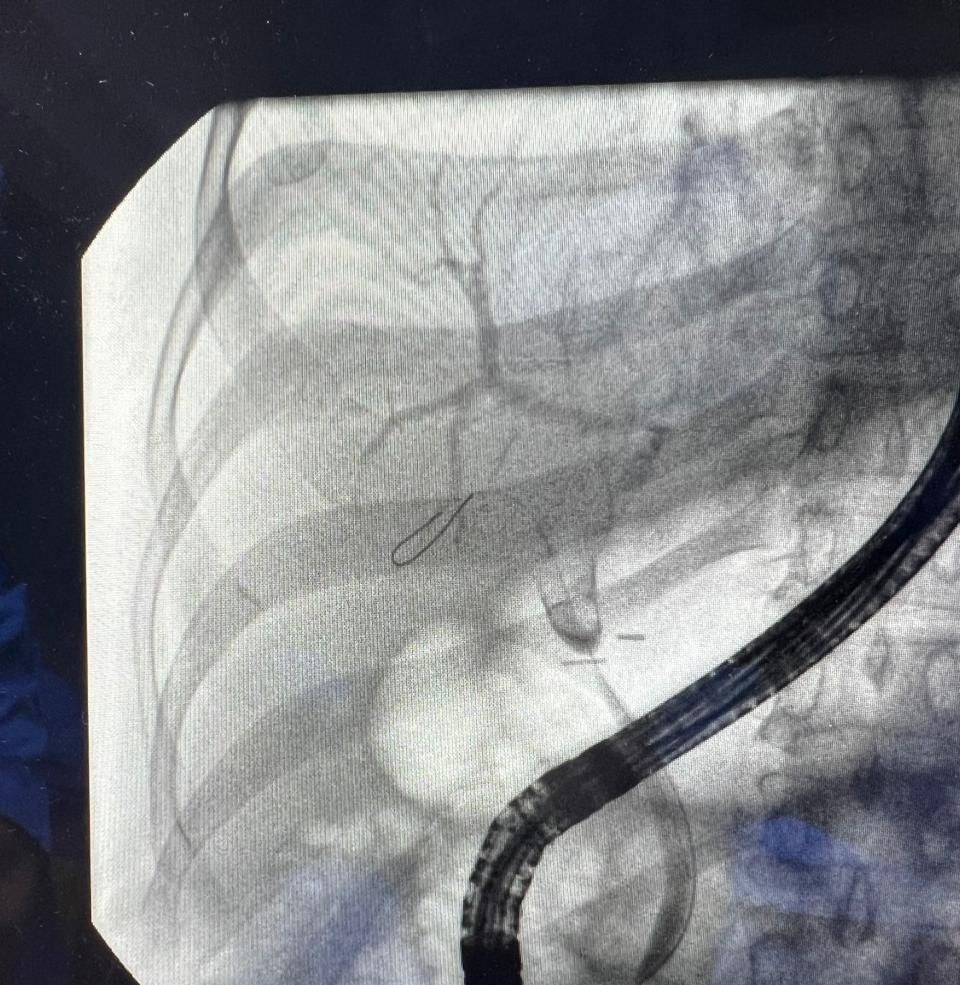 Second Fluoroscopy Still From The Ercp