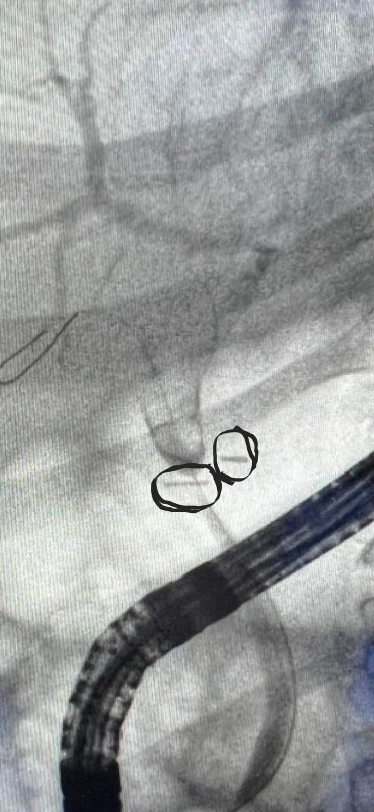 Fluoroscopy Still With Two Surgical Clips Circled
