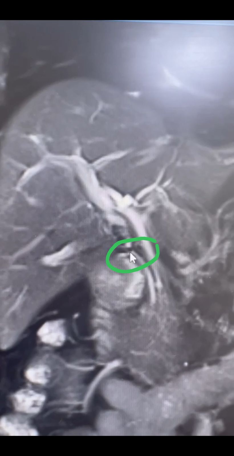 Mri Image With The Clip Circled