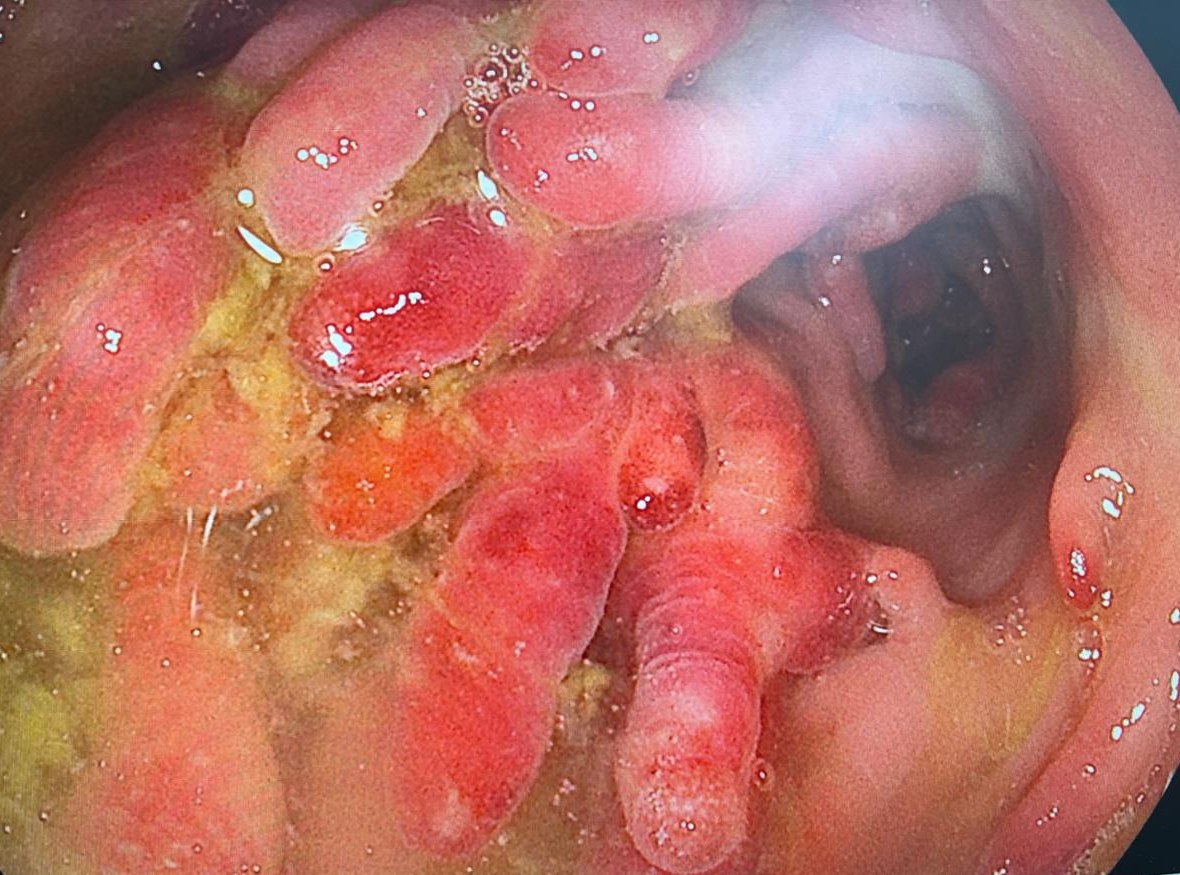 Gi Endoscopy Community &Amp; Education - Endocollab 1 Gi Endoscopy Community &Amp; Education - Endocollab