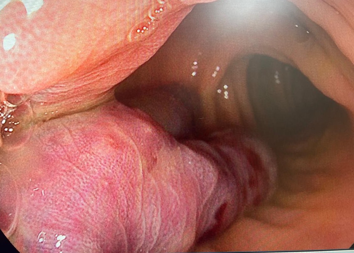 Close View Of A Large Inflammatory Polyp In The Colon.