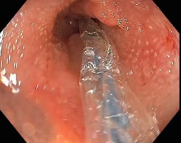 Through-The-Scope Dilation Balloon Advanced Into The Anastomotic Stricture