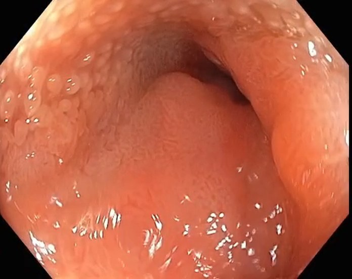 Narrowed Ileocolic Anastomosis With An Eccentric Lumen And Nodular Mucosa Beside It.