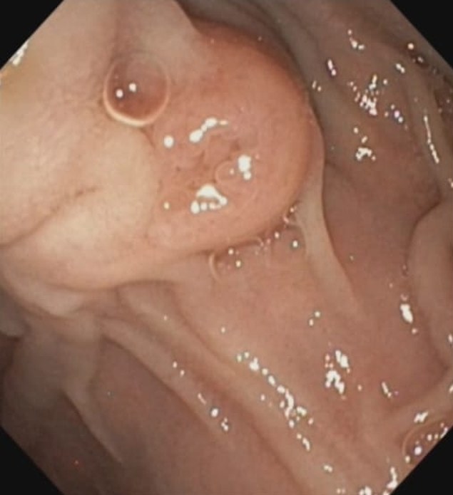 Duodenoscope View Of The Major Papilla Seen At A Tangential Angle.