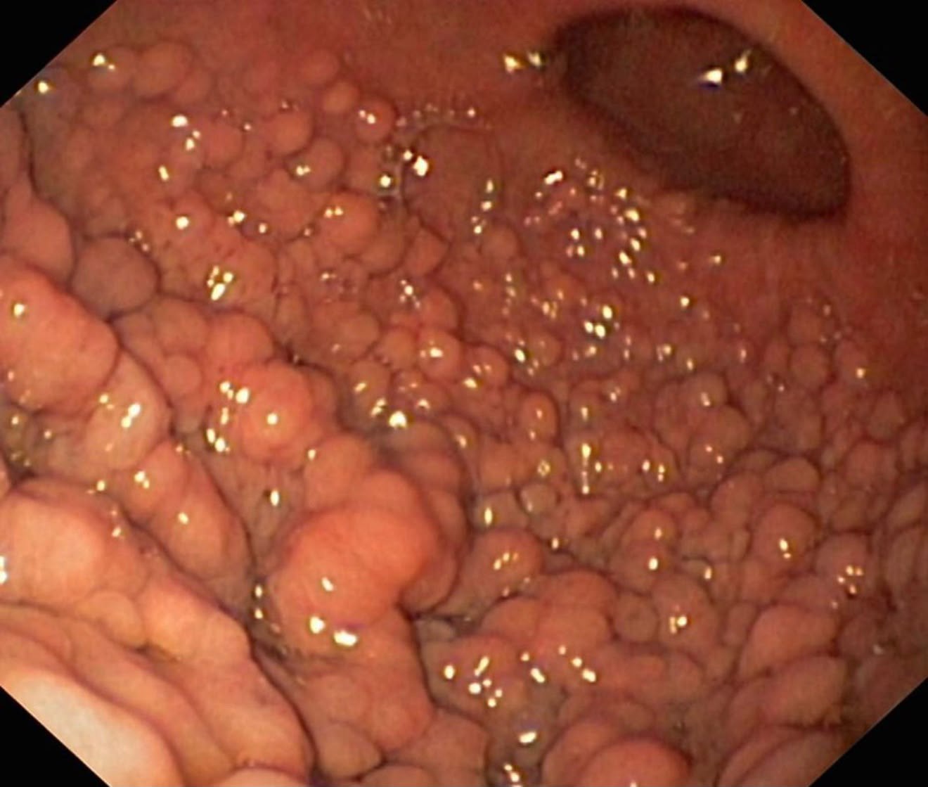 Gastric Antrum Carpeted With Many Small Sessile Polyps, Pylorus At The Top Right