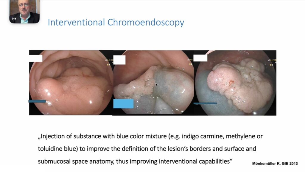 Interventional chromoendoscopy: three views of a colon polyp lifted on a blue submucosal cushion