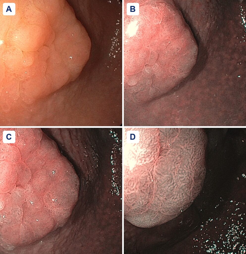 Four endoscopic views of a 2 cm gastric adenoma near the incisura: white light (A) and narrow-band imaging (B to D)