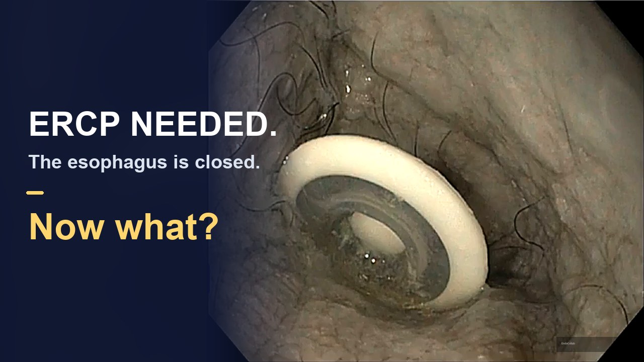 Extreme Ercp: Getting A Duodenoscope Through A Closed Esophagus