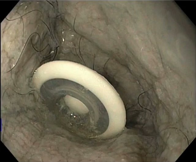 Extreme Ercp: Getting A Duodenoscope Through A Closed Esophagus 2 Endoscopic View Of A Skin Graft With Hair Around A Speech Valve In A Stenosed Esophagus