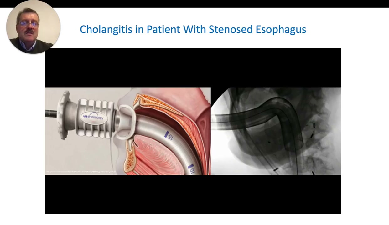 Extreme Ercp: Getting A Duodenoscope Through A Closed Esophagus 3 Diagram Of An Overtube In The Esophagus Beside A Fluoroscopy Image Of The Duodenoscope Inside The Overtube