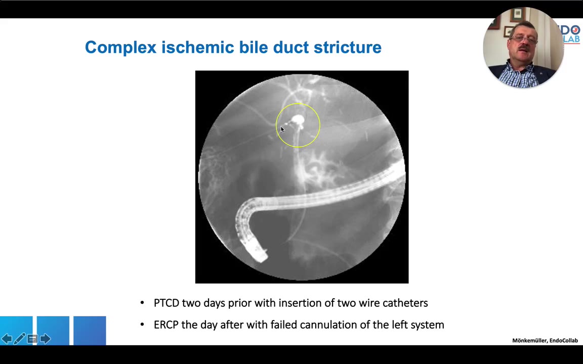 Case Slide: Complex Ischemic Bile Duct Stricture. Ptcd Two Days Prior With Two Wire Catheters, Ercp The Day After With Failed Cannulation Of The Left System