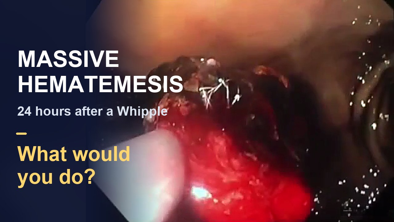 Massive Hematemesis The Day After A Whipple: What Would You Do?