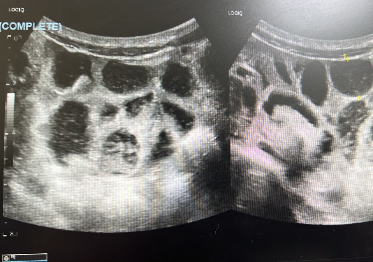 Ultrasound Image The Presenter Labelled Bowel Loops