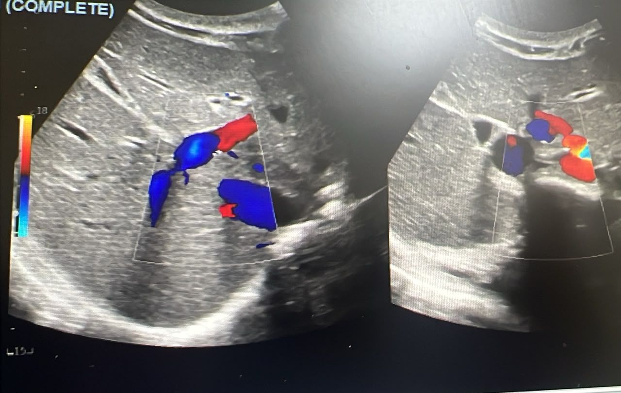 Ultrasound Image The Presenter Described As A Normal Liver