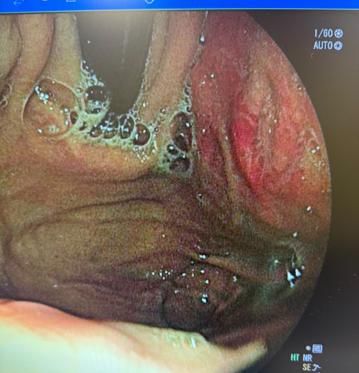 Endoscopic Image Of The Cardia Lesion