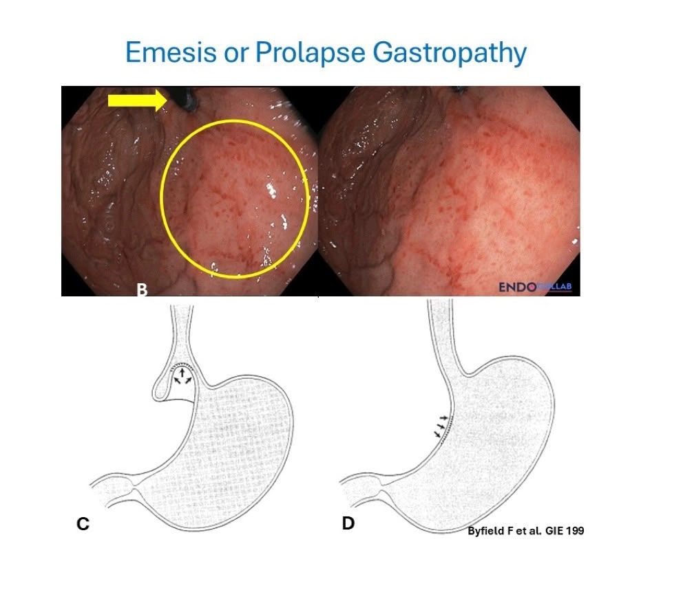 Slide Titled Emesis Or Prolapse Gastropathy