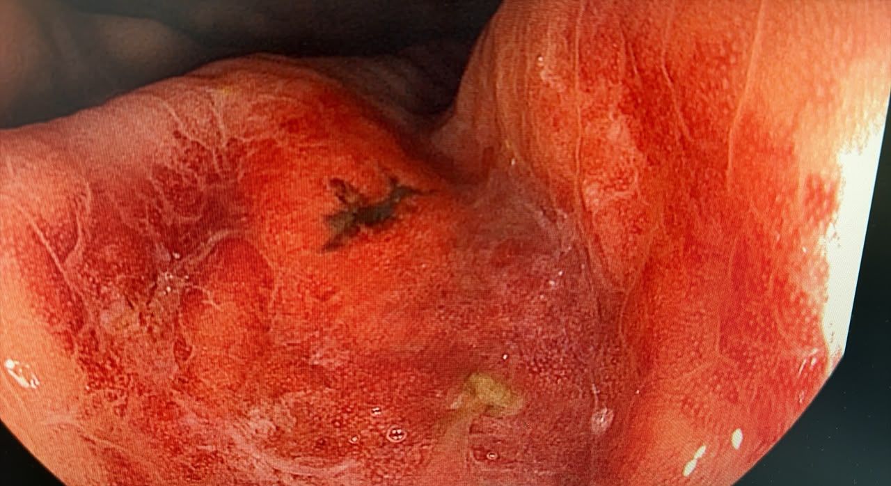 Endoscopic Image Of The Gastric Body