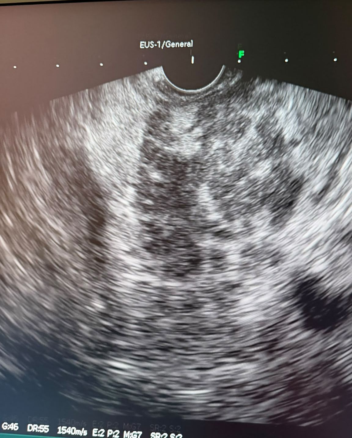 Eus Image Of The Pancreatic Head Lesion
