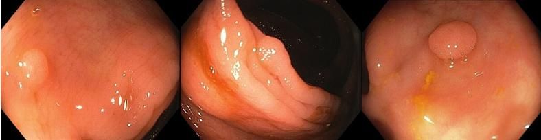 Three Endoscopic Images Posted With The Polls