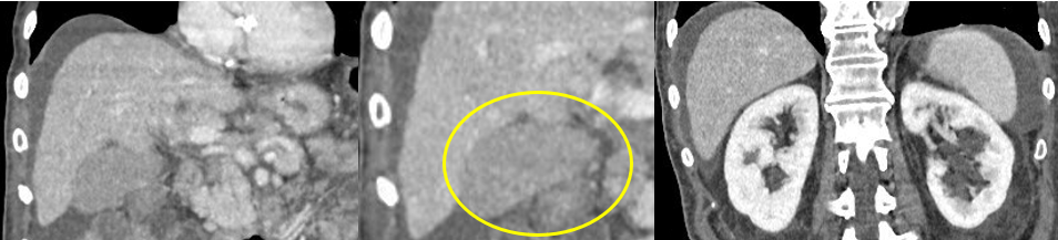 Coronal Ct Images Showing A Hyperdense Gallbladder From Vicarious Excretion Of Iodinated Contrast, Circled In Yellow